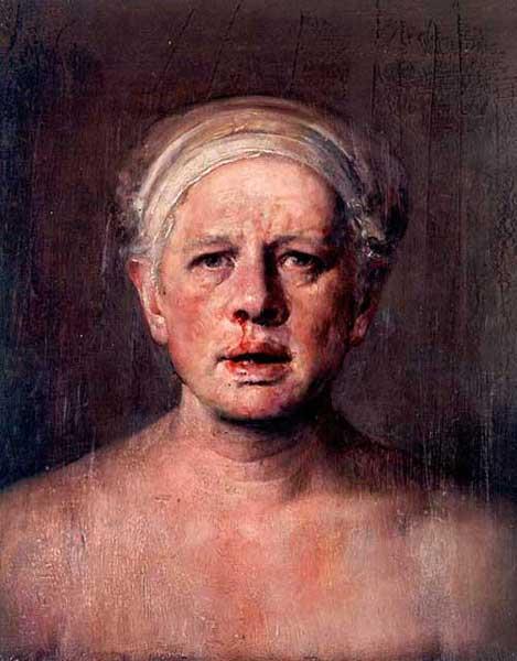 Self Portrait with Nose Bleed - Odd Nerdrum